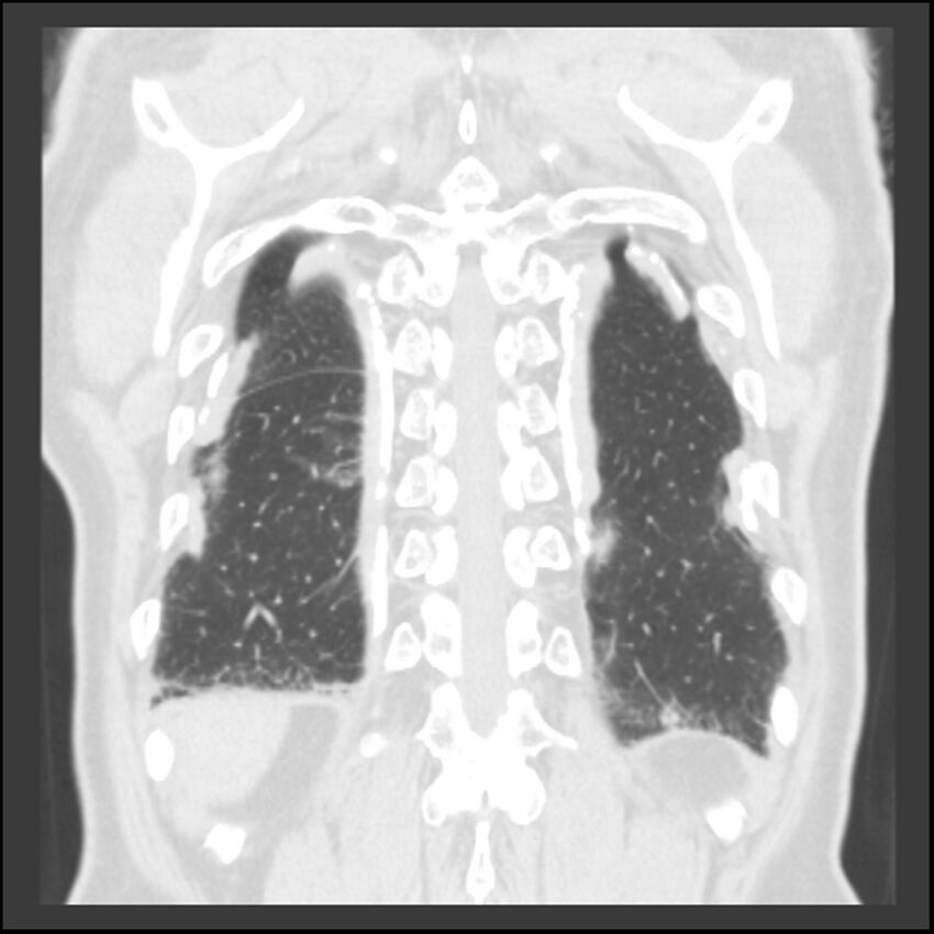 Asbestos-related pleural plaques (Radiopaedia 39069-41255 Coronal lung window 13).jpg