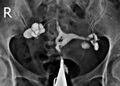 Asherman syndrome and bilateral hydrosalpinges (Radiopaedia 85444-101081 D 1).jpg