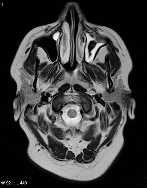 File:Astroblastoma (Radiopaedia 39792-42217 Axial T2 19).jpg