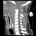 Atlanto-occipital dislocation (Radiopaedia 44648-48412 A 14).jpg