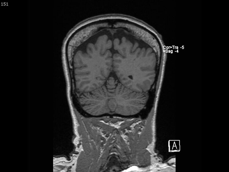 File:Atypical meningioma - intraosseous (Radiopaedia 64915-74572 Coronal T1 151).jpg