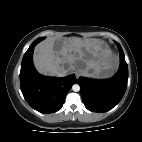File:Autosomal dominant polycystic kidney disease (Radiopaedia 23061-23093 B 9).jpg