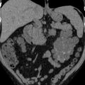 Autosomal dominant polycystic kidney disease (Radiopaedia 36539-38101 Coronal non-contrast 14).jpg