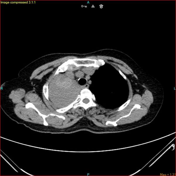 File:Azygos vein aneurysm (Radiopaedia 77824-90130 A 14).jpg