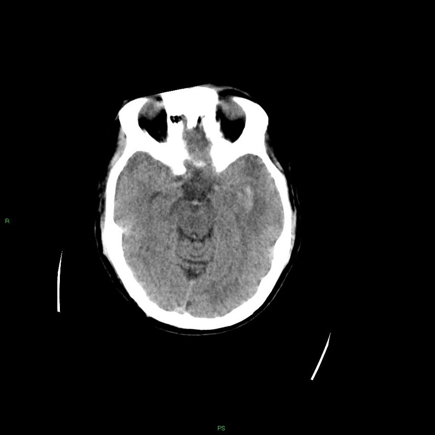 Basal ganglia hemorrhage (Radiopaedia 58349-65472 Axial non-contrast 37).jpg