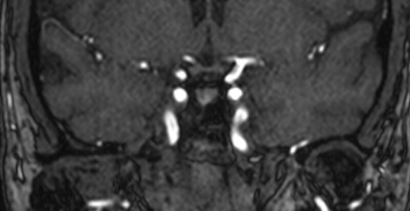 File:Basilar artery fenestration (Radiopaedia 74537-85455 Coronal MRA TOF 15).jpg