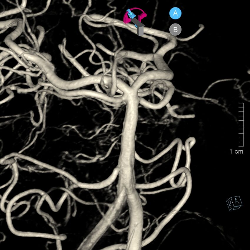 Basilar artery perforator aneurysm (Radiopaedia 82455-97734 3D view left VA 50).jpg