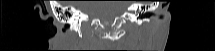 Basilar impression (Radiopaedia 52411-58522 Coronal bone window 91).jpg