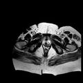 Benign seromucinous cystadenoma of the ovary (Radiopaedia 71065-81300 B 1).jpg
