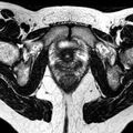 Bicornuate uterus (Radiopaedia 11104-11492 Axial T2 8).jpg