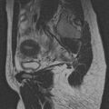 Bicornuate uterus (Radiopaedia 24677-24949 B 2).jpg