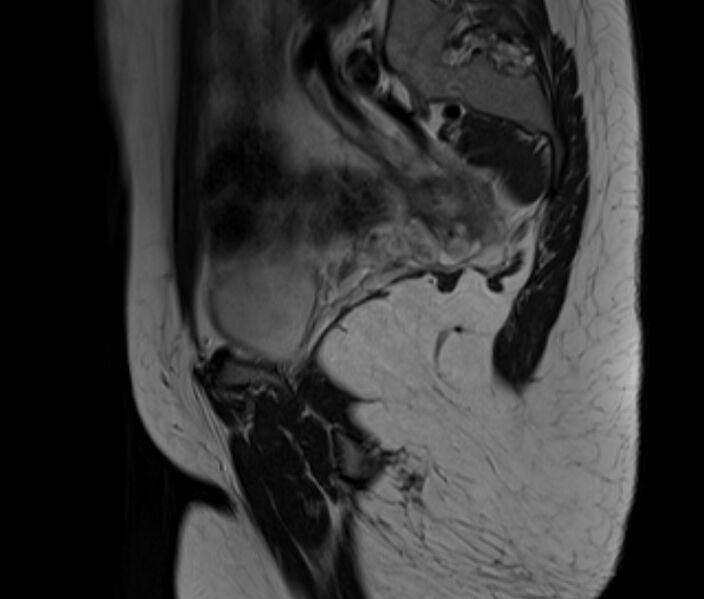 File:Bicornuate uterus (Radiopaedia 71214-81511 Sagittal T2 5).jpg