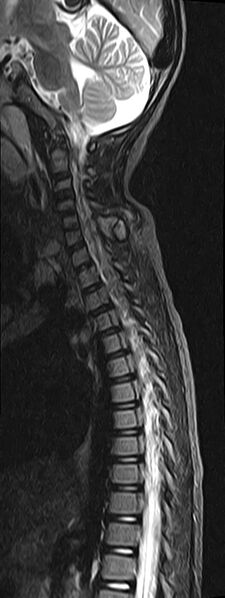 File:Bilateral Sprengel deformity with Klippel-Feil syndrome (Radiopaedia 66395-75650 Sagittal STIR 8).jpg