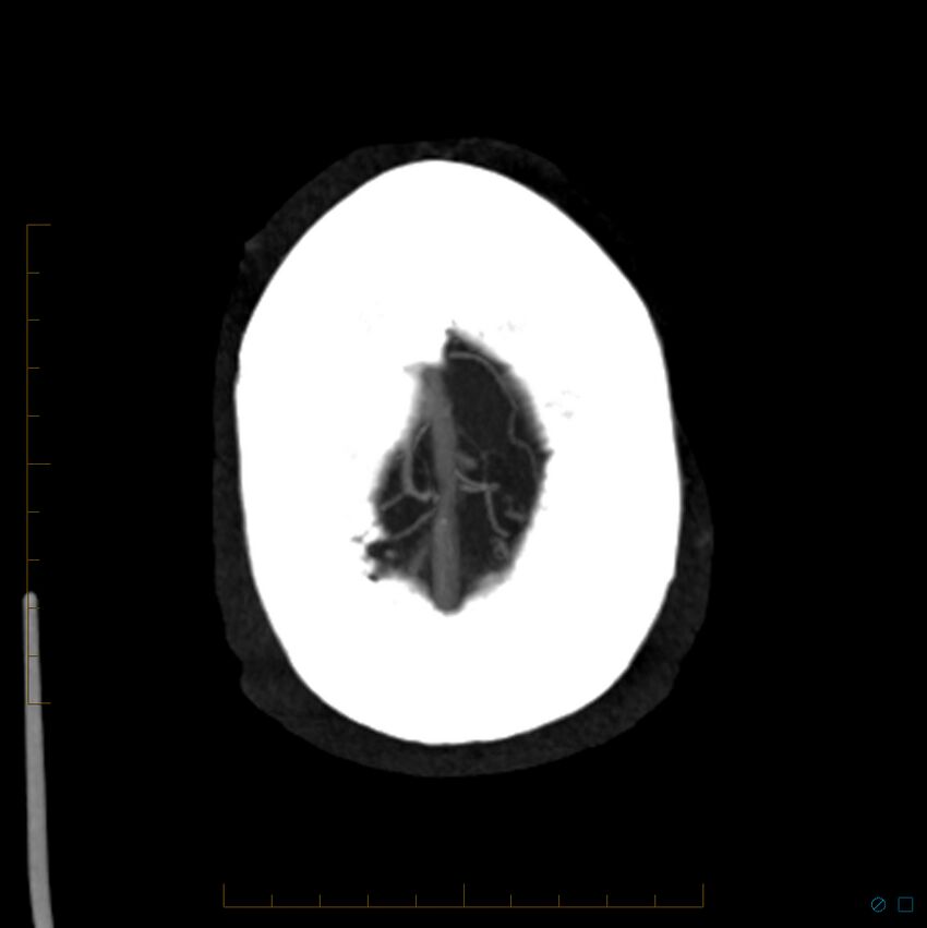 Bilateral chronic common carotid occlusion (Radiopaedia 50849-56362 D 3).jpg