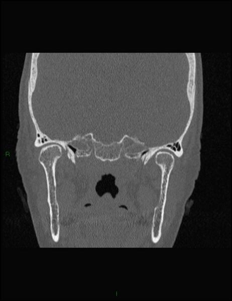 File:Bilateral frontal mucoceles (Radiopaedia 82352-96454 Coronal 274).jpg