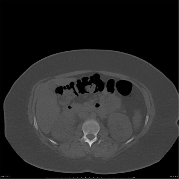 File:Bilateral lumbar ribs (Radiopaedia 25862-26010 bone window 15).jpg