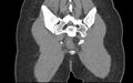 Bilateral mature cystic ovarian teratoma (Radiopaedia 88821-105592 Coronal non-contrast 42).jpg