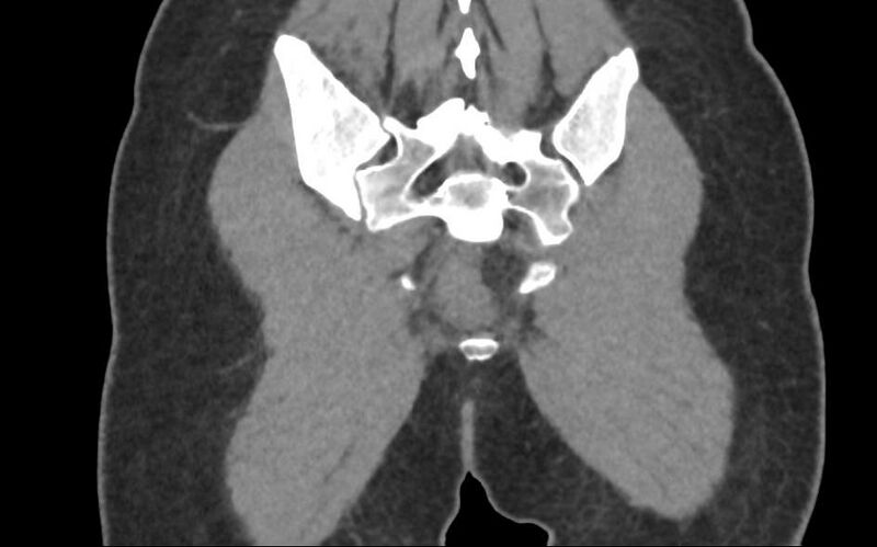 File:Bilateral mature cystic ovarian teratoma (Radiopaedia 88821-105592 Coronal non-contrast 42).jpg