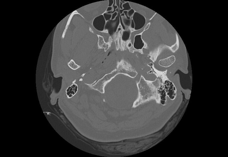 File:Bilateral otospongiosis (Radiopaedia 35447-36940 Axial bone window 4).jpg