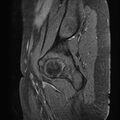 Bilateral ovarian endometriomas (Radiopaedia 87085-103347 F 2).jpg