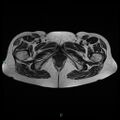 Bilateral ovarian fibroma (Radiopaedia 44568-48293 Axial T2 29).jpg