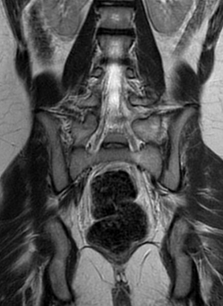 File:Bilateral ovarian fibrothecomas - adolescent (Radiopaedia 86604-102707 Coronal T2 24).jpg