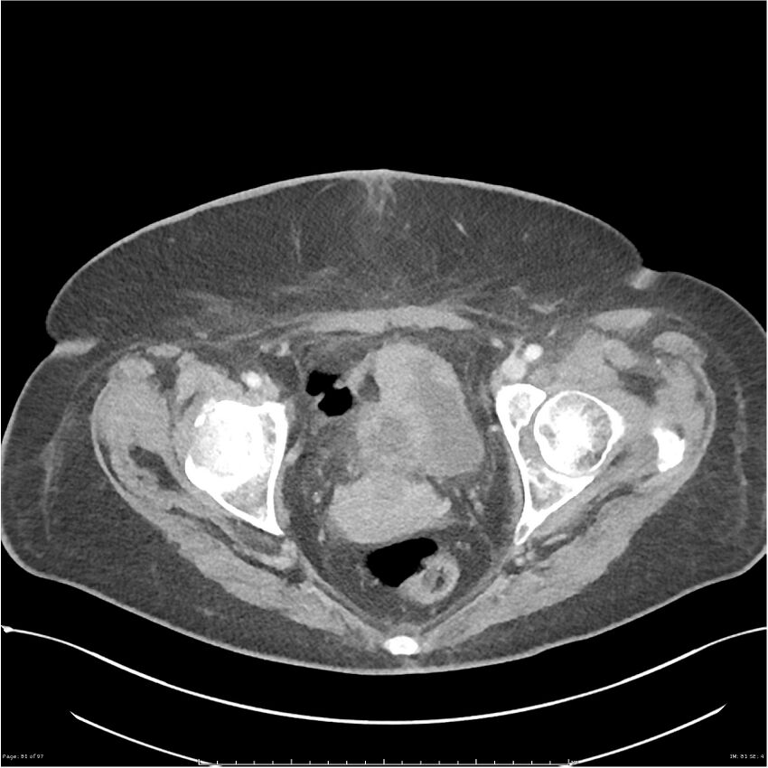 Bilateral psoas hematomas (Radiopaedia 24057-24279 A 81).jpg
