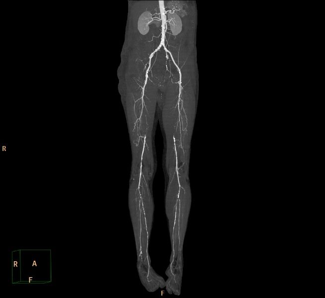 File:Bilateral superficial femoral arterial occlusion (Radiopaedia 25682-25857 3D MIP 2).jpg