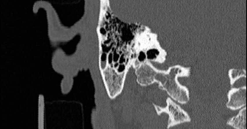 Bilateral temporal bone fractures (Radiopaedia 29482-29970 Coronal non-contrast 139).jpg