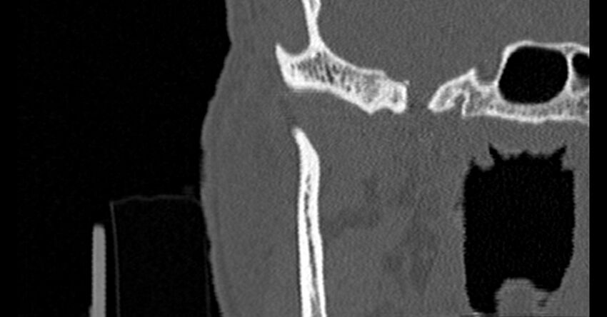 Bilateral temporal bone fractures (Radiopaedia 29482-29970 Coronal non-contrast 22).jpg
