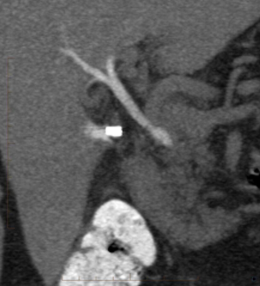 Bile leak from accessory duct(s) of Luschka post cholecystectomy (Radiopaedia 40736-43389 B 33).jpg