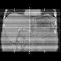 Bile leak post laparoscopic cholecystectomy (Radiopaedia 29014).jpg