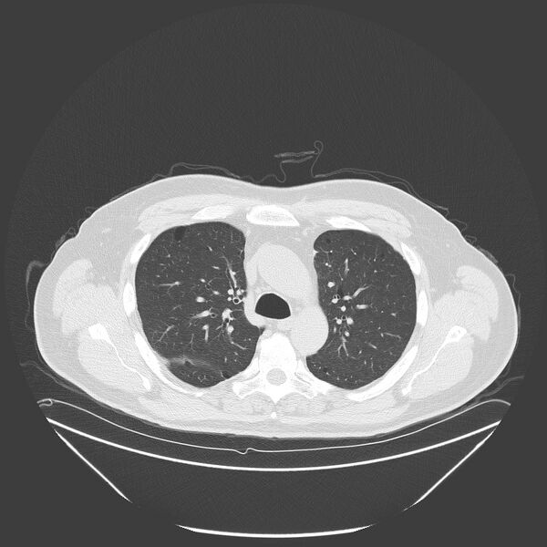 File:Birt-Hogg-Dubé syndrome (Radiopaedia 52578-58491 Axial lung window 19).jpg