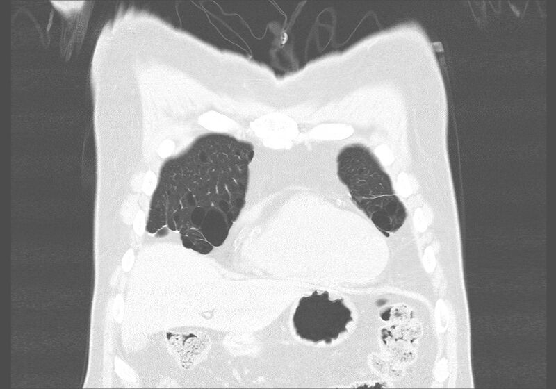 File:Birt-Hogg-Dubé syndrome (Radiopaedia 52578-58491 Coronal lung window 4).jpg