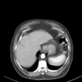 Bladder papillary urothelial carcinoma (Radiopaedia 48119-52951 A 2).png