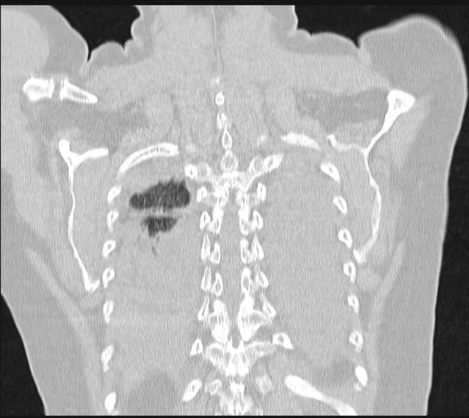 File:Boerhaave syndrome (Radiopaedia 45644-49799 Coronal lung window 59).jpg