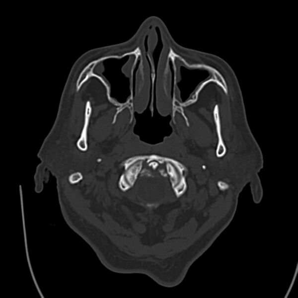File:Brain Pantopaque remnants (Radiopaedia 78403-91048 Axial bone window 11).jpg