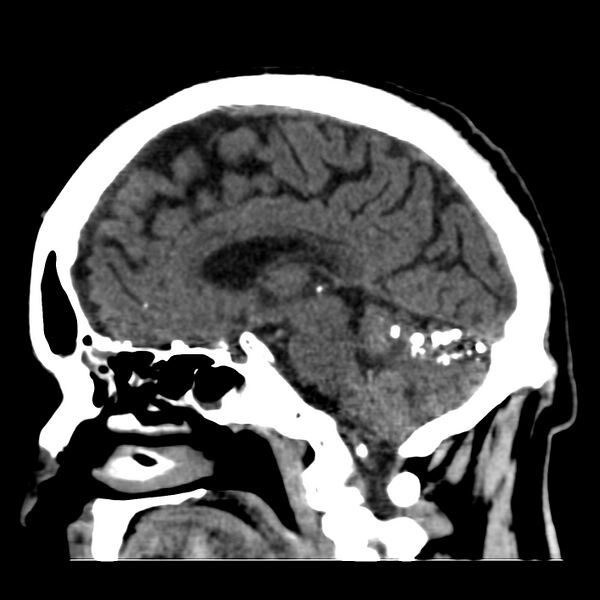 File:Brain Pantopaque remnants (Radiopaedia 78403-91048 C 27).jpg