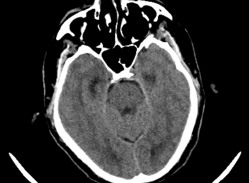 File:Brain abscess complicated by intraventricular rupture and ventriculitis (Radiopaedia 82434-96575 Axial non-contrast 1).jpg