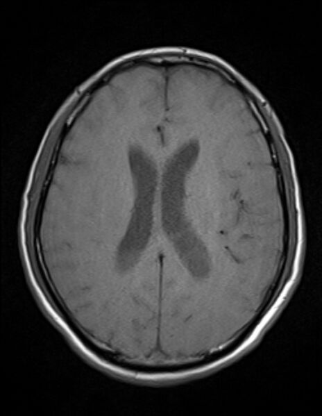 File:Brain abscess with ventriculitis (Radiopaedia 85703-101495 Axial T1 17).jpg