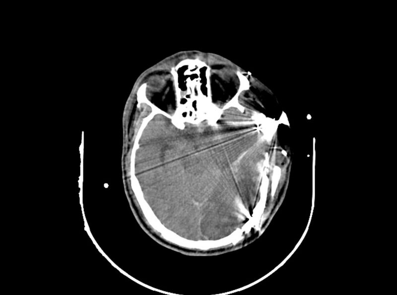 File:Brain injury by firearm projectile (Radiopaedia 82068-96087 B 87).jpg