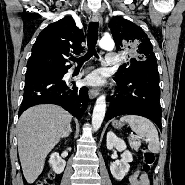 File:Brain metastases - lung cancer primary (Radiopaedia 75060-86116 C+ arterial phase 38).jpg