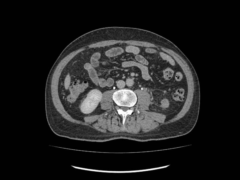 File:Brain metastases from renal cell carcinoma (Radiopaedia 42222-45328 Axial C+ delayed 156).jpg