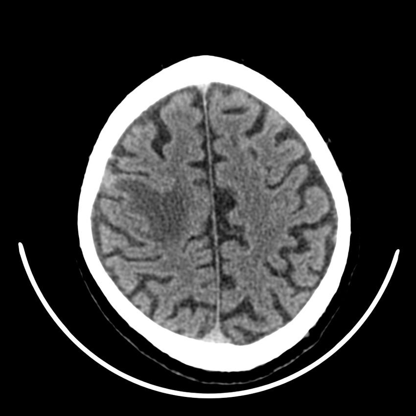 Brain metastasis (Radiopaedia 42617-45760 Axial non-contrast 38).jpg