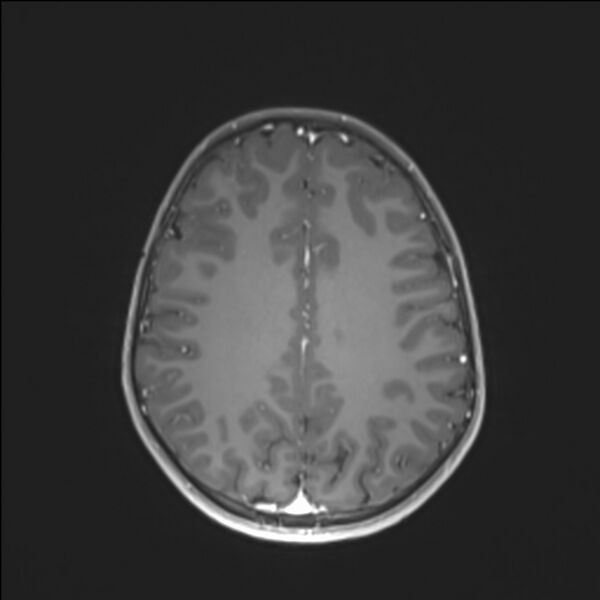 File:Brainstem glioma (Radiopaedia 70548-80674 Axial T1 C+ 108).jpg