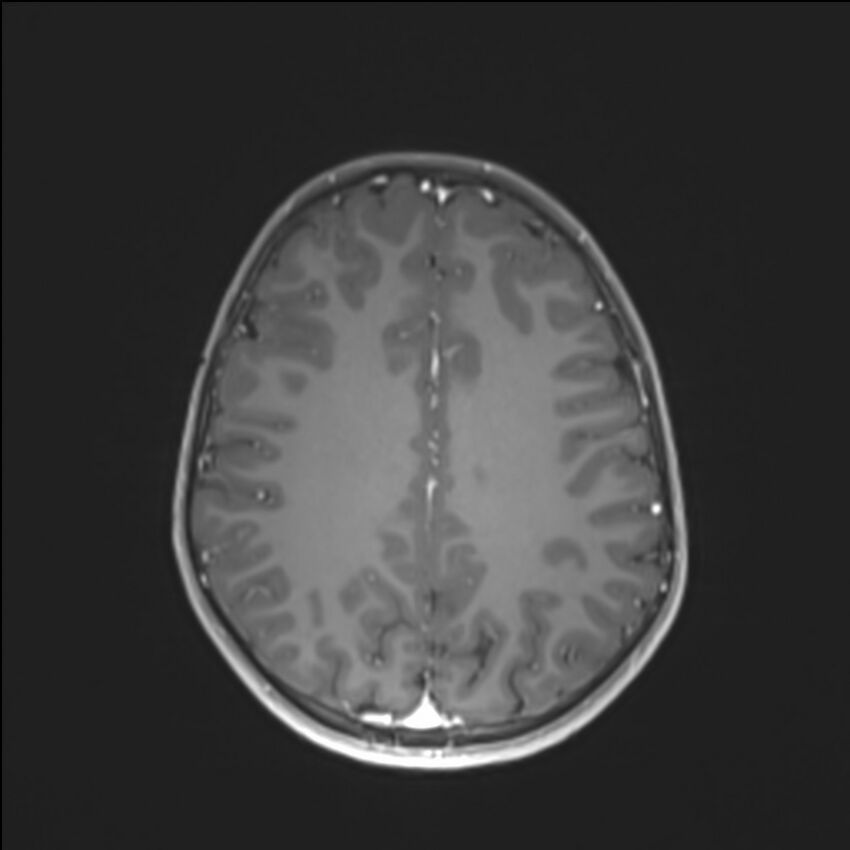 Brainstem glioma (Radiopaedia 70548-80674 Axial T1 C+ 108).jpg