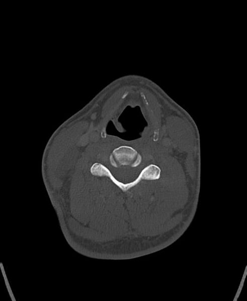 File:Branchial cleft cyst (Radiopaedia 31167-31875 Axial bone window 43).jpg