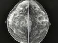 Breast areolar calcification (Radiopaedia 17869-17628 A 1).JPG
