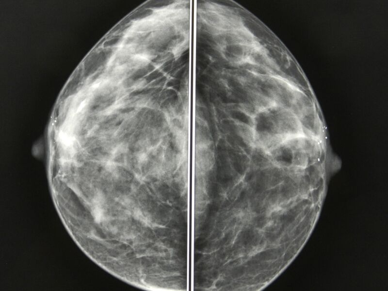 File:Breast areolar calcification (Radiopaedia 17869-17628 A 1).JPG