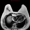 Breast carcinoma (multicentric multifocal in mammary Paget disease) (Radiopaedia 50966-56512 Axial T1 2).jpg